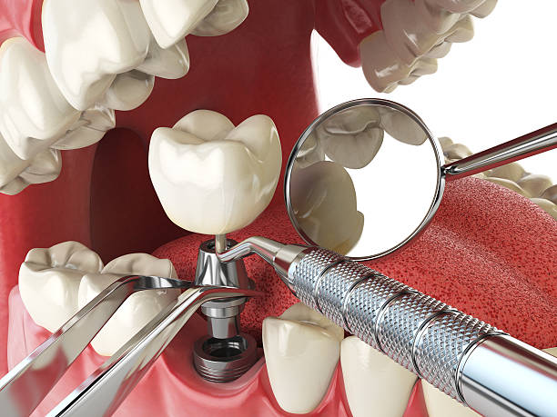 Best Lost Filling or Crown Replacement in Summerfield, MD